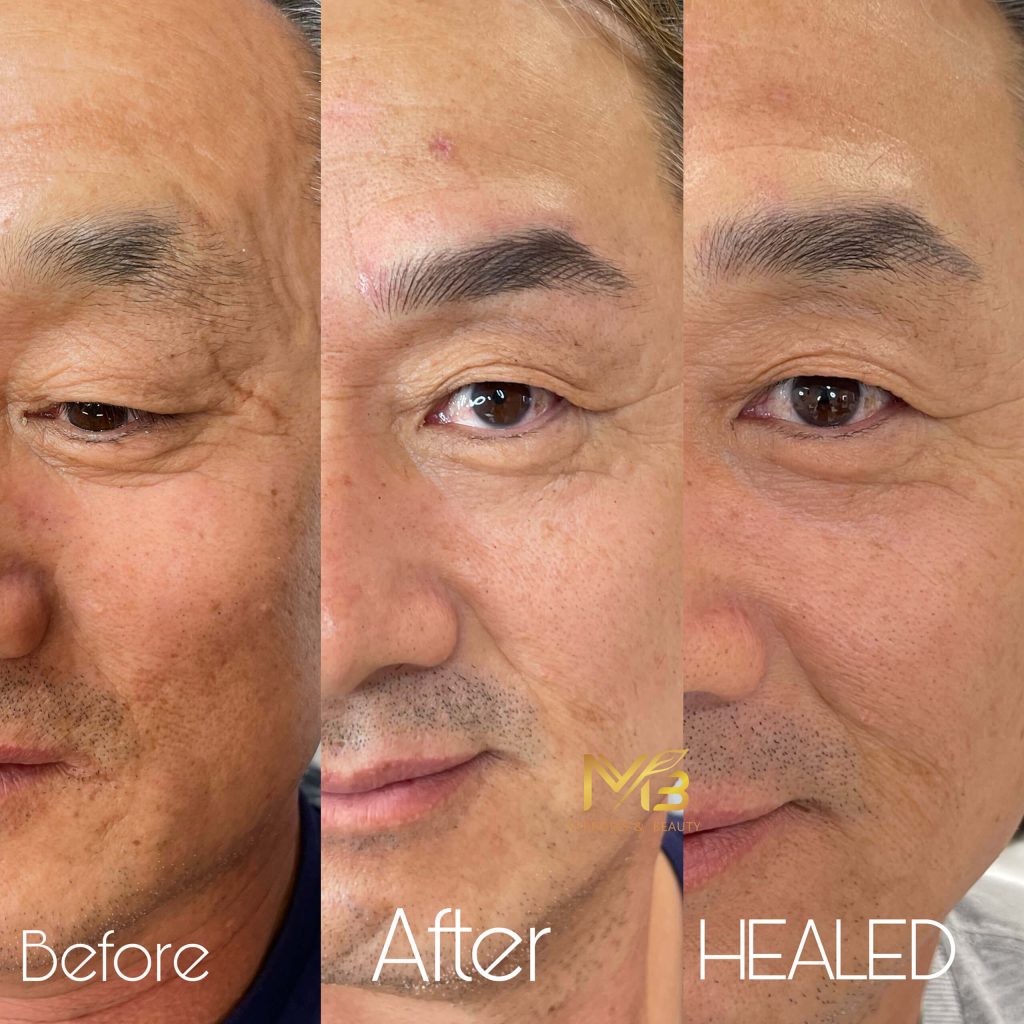 M Brows and Beauty Close-up of a man's face in three stages: "Before" with sparse eyebrows, "After" with fuller brows enhanced by permanent make-up, and "Healed" featuring natural-looking, shaped eyebrows. Text labels each stage.