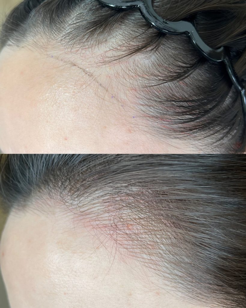 M Brows and Beauty Close-up comparison of a person’s hairline before and after a nano hairline procedure in Sydney, showing reduced redness and improved appearance. Hair is pulled back with a black hairband in both images. The results highlight the benefits of nano machine hairstrokes for men, offering a natural-looking enhancement similar to those achieved nano hairline.