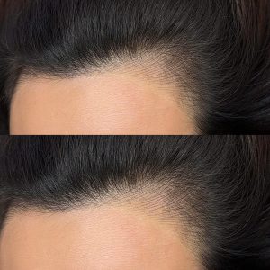 M Brows and Beauty Two close-up views of a person’s hairline and forehead, showing a before-and-after anno hairline tattoo comparison. The bottom image highlights fuller, darker hair along the hairline compared to the top image, demonstrating the impressive results that can be achieved with nano machine hairstrokes for men.