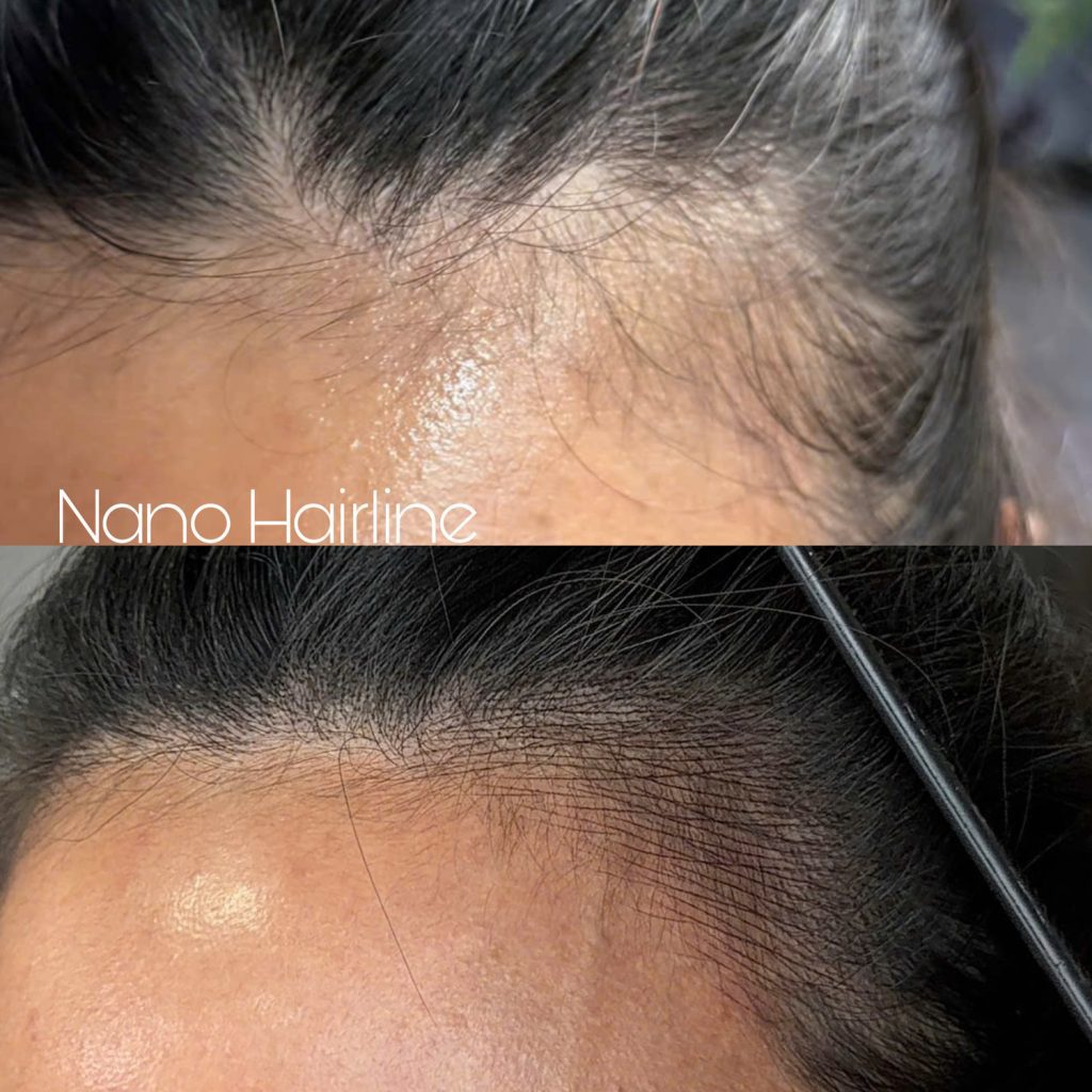 M Brows and Beauty Close-up of a person’s hairline before and after a nano hairline treatment; the top image shows thinning hair, whilst the bottom image reveals a fuller, more defined hairline. Sydney specialists offer, delivering natural-looking results for men and women seeking enhanced definition.